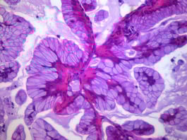 Ovarian cancer and STAT3